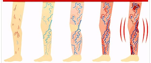 co nedělat s křečovými žilami