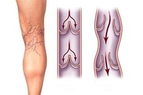 odtok krve v křečových žilách v různých fázích vývoje onemocnění